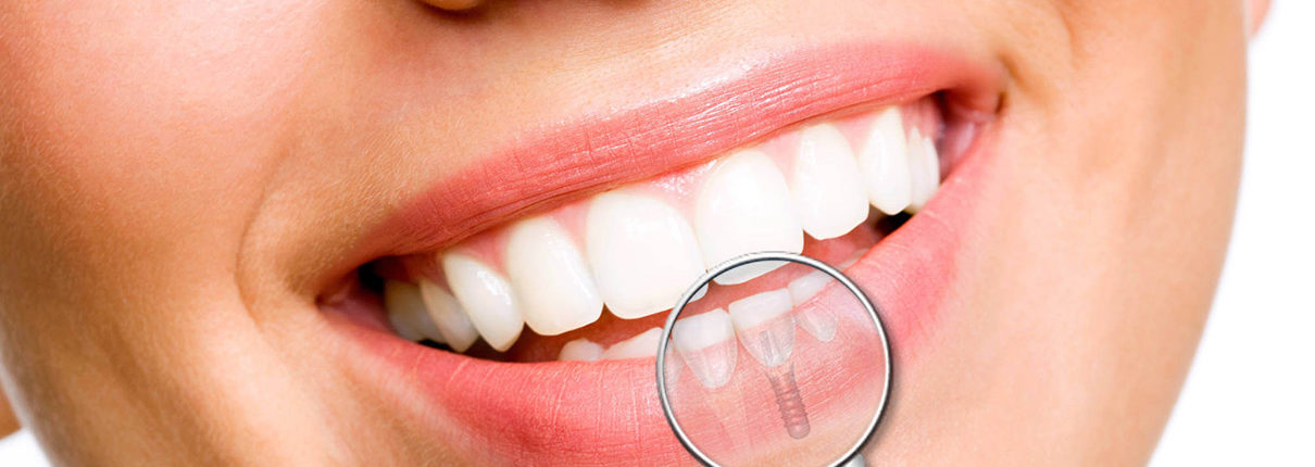 Implantologia_Dentale