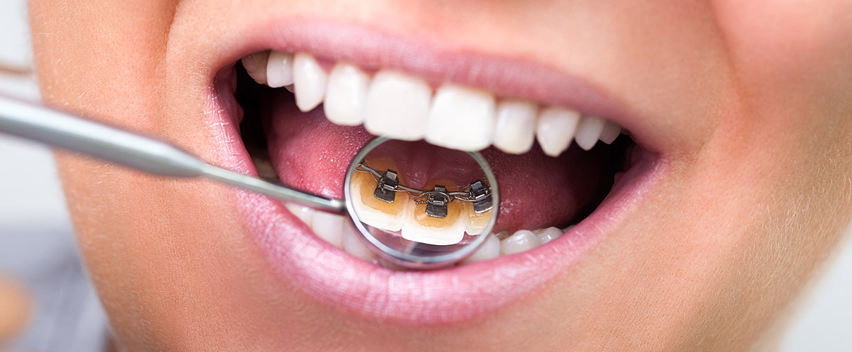 invisible lingual braces