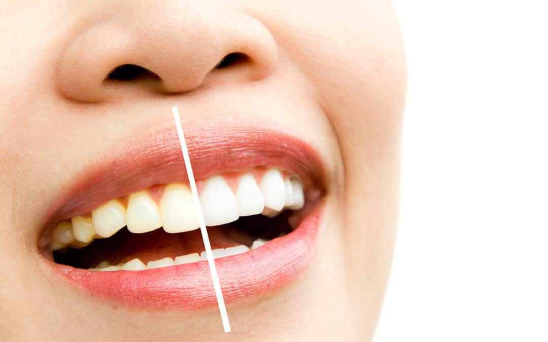 SBIANCAMENTO DENTI NATURALI